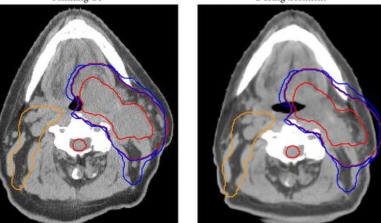 Adaptif Radyoterapi-1