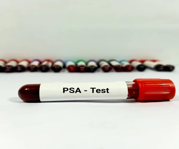 psa-degeri